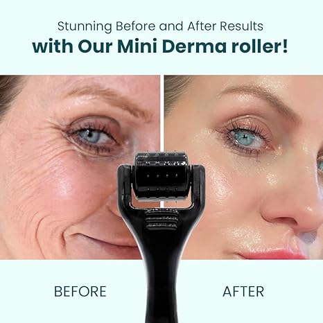 Gin Amber Beauty Mini Derma roller (0.25mm) - 48 Real Individual Needles, Microdermabrasion Device for Skin Care, Serum Absorption with Microneedling, Tool, Hygienic Case (Black Mini 0.25mm) - Image 4